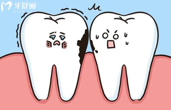 虫牙如何选择补牙或拔牙