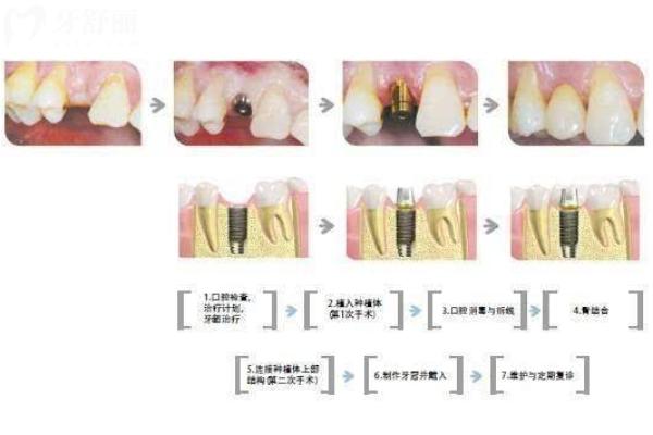 数字化种植牙和传统种植牙的区别