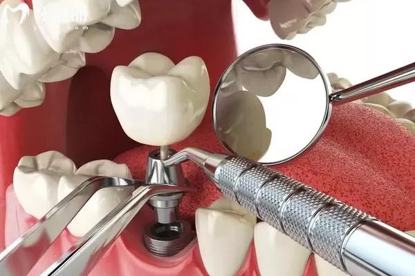 种植牙对旁边的牙齿会有影响吗