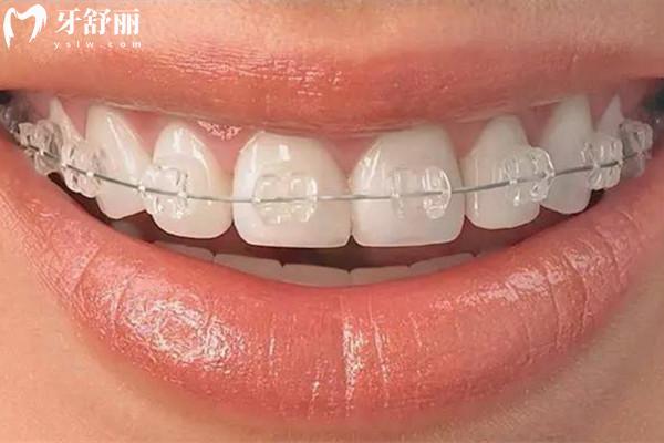 牙齿矫正越疼越有疗效吗