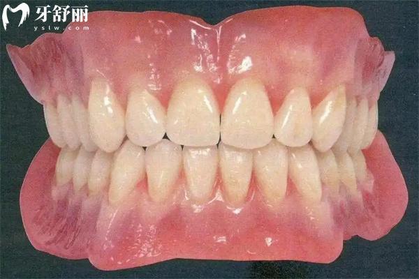 上海老人做一口吸附性义齿需要多少钱