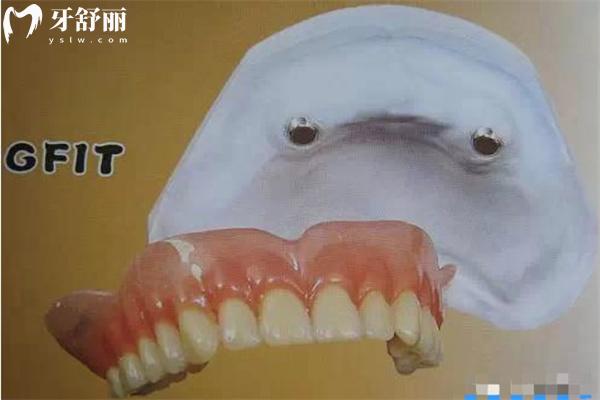 上海老人装全口半固定种植牙多少钱