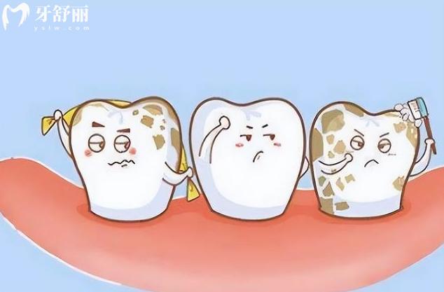 牙齿上有牙菌斑怎么去除