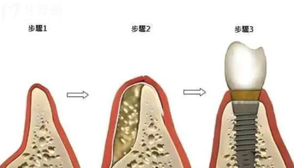 缺牙多年牙槽骨吸收还能种牙吗