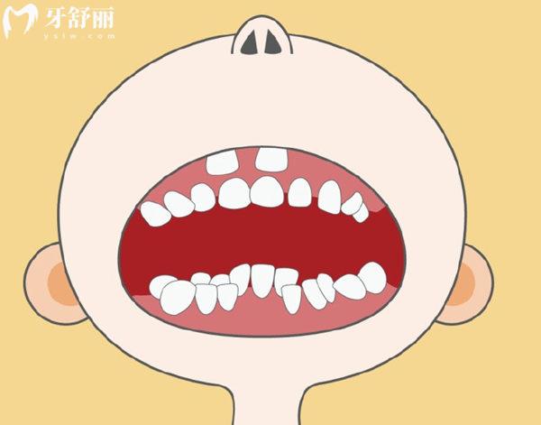 双排牙形成的原因有哪些