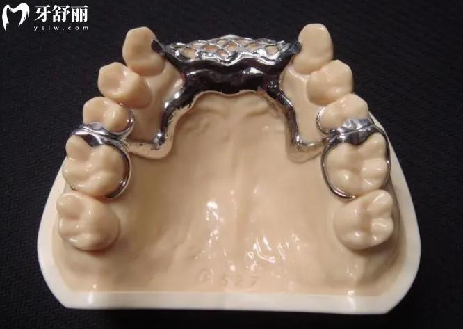 peek活动义齿支架的优点和缺点