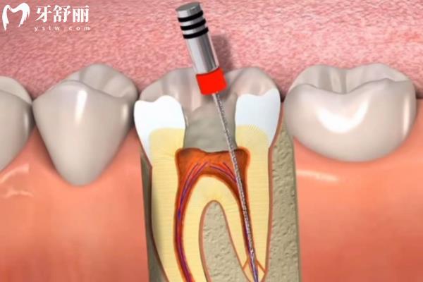 急性牙髓炎和慢性牙髓炎有什么区别？