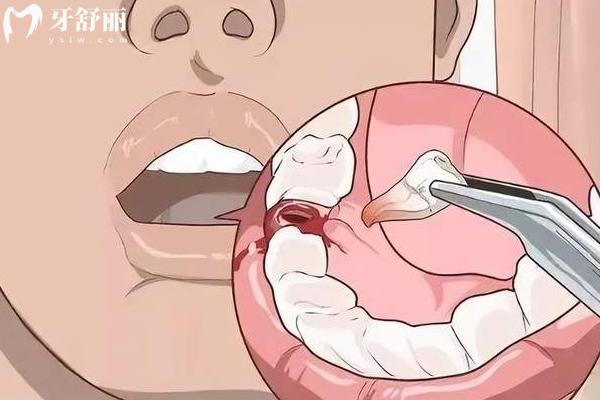 怀孕期间能看牙吗？