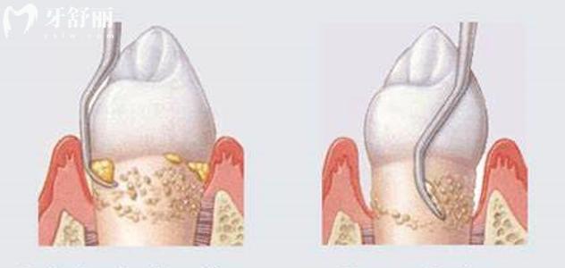 龈下刮治能治好牙周炎吗