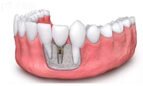 种植牙齿疼吗+种植牙齿需要住院吗？种植牙的相关基本内容一文告知