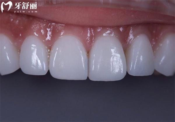 牙齿贴面美白靠谱性探讨：是否会损害牙齿健康？