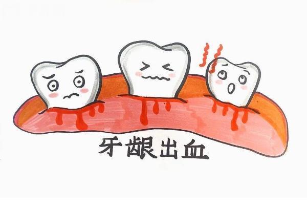 为什么刷牙总是出血？详细介绍原因+预防+治疗