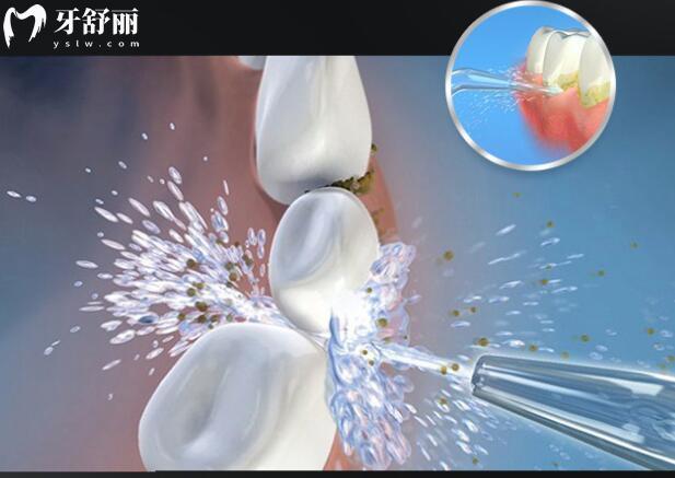 解析冲牙器：快速升级你的口腔护理知识