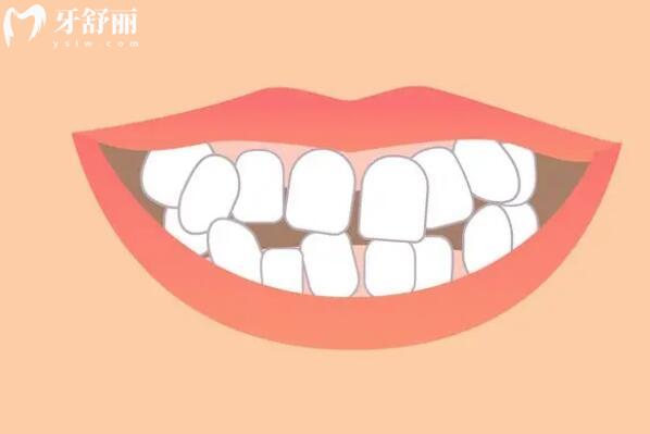 牙齿间隙变宽：是哪些因素在作祟？