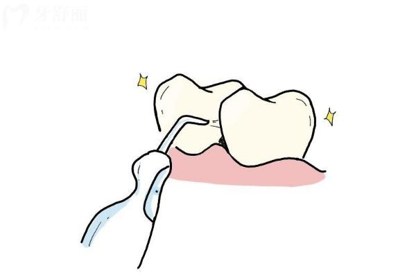 牙医为什么推荐用冲牙器？做到清洁到位才可以保护口腔