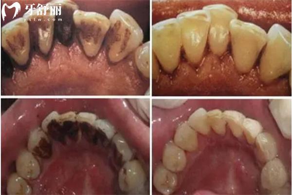 牙结石洗牙前后图片对比